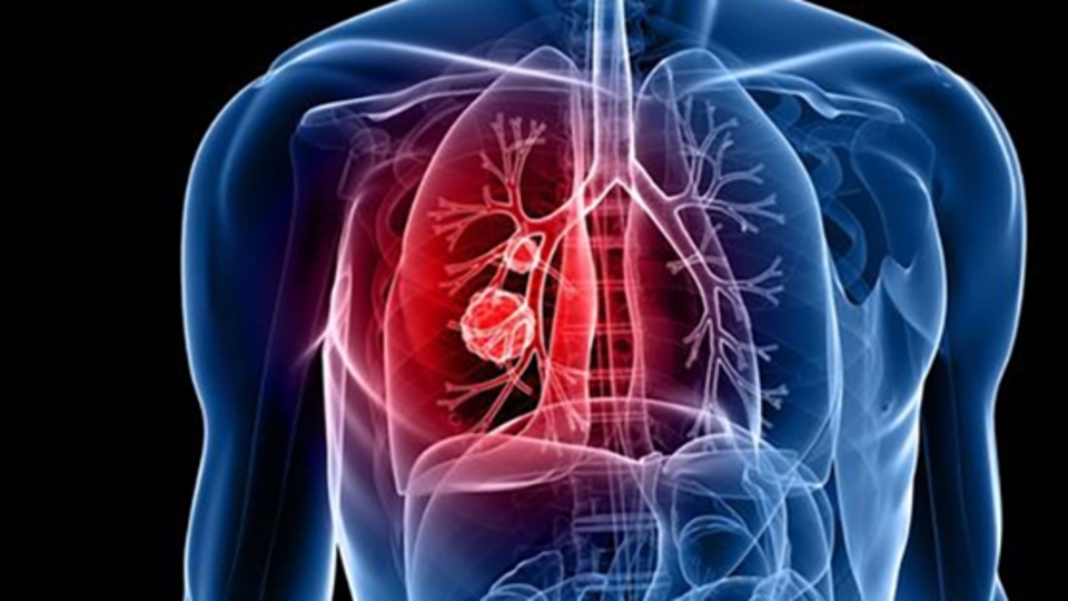 Plörezi hastalığının sebepleri ve belirtileri