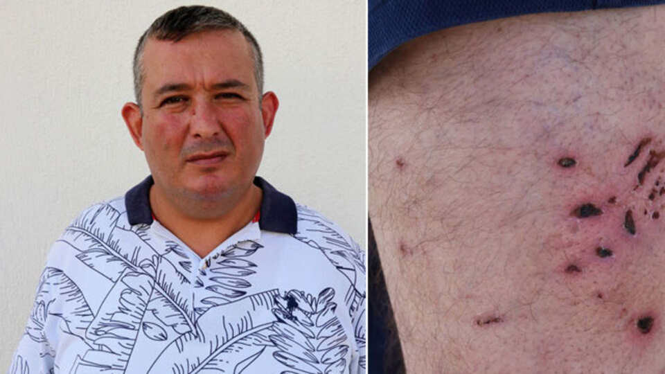 Tatilde akılalmaz olay! 40 dikiş atıldı! Pitbull dehşeti!