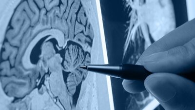 ALS hastalığı nedir?