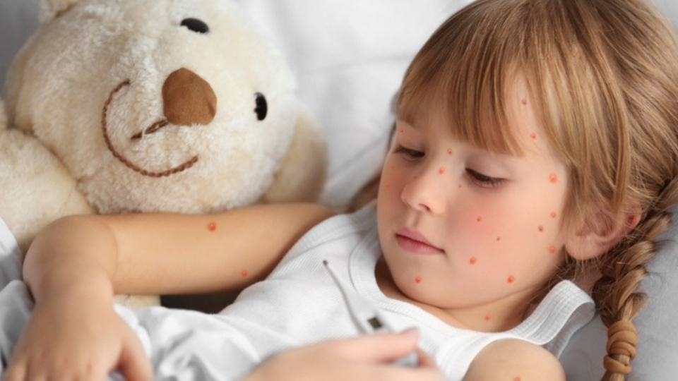 Kızamık belirtileri ve tedavi uygulamaları