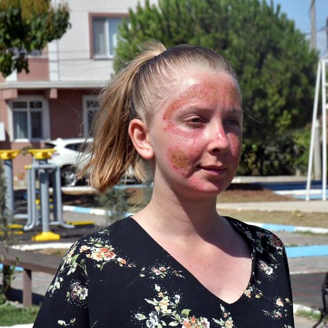 Cilt bakımı kâbusa döndü!