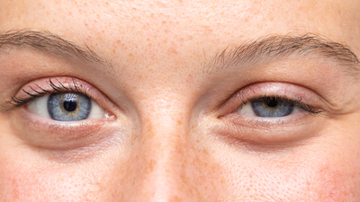 Göz kapağı düşüklüğü neden olur?