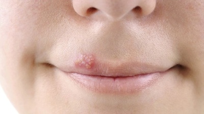 Uçuk nedenleri ve tedavisi