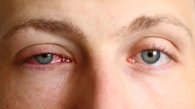 Mikrop kapan göz için tedavi uygulamaları