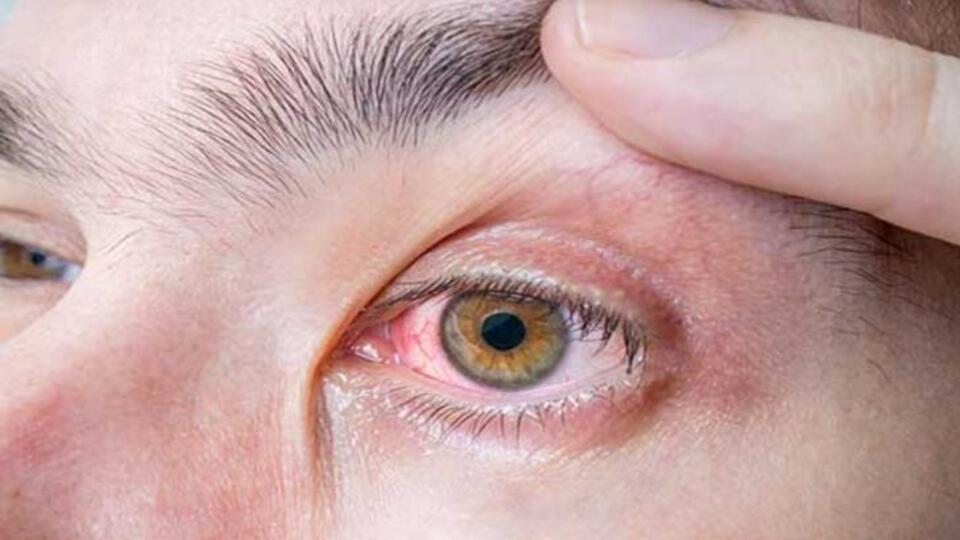 Göz ağrısına karşı etkili uygulamalar