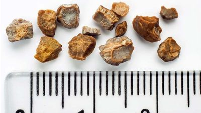 Böbrek taşından korunmak için 3 altın kural