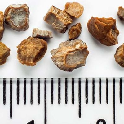 Böbrek taşından korunmak için 3 altın kural