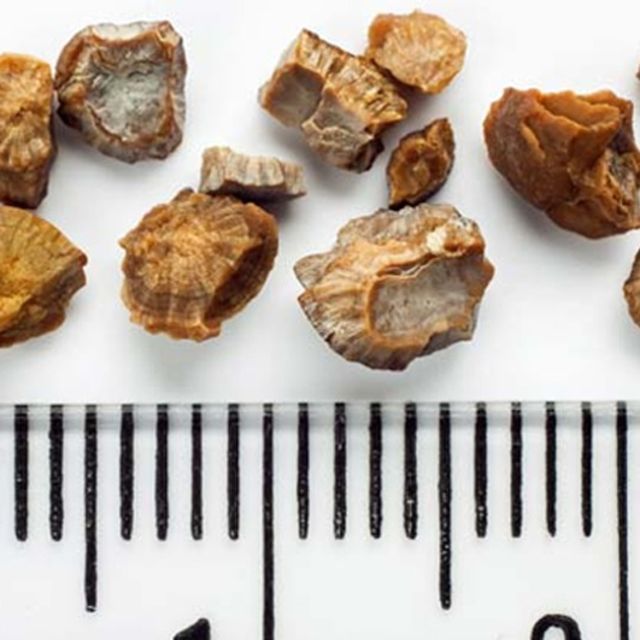 Böbrek taşından korunmak için 3 altın kural