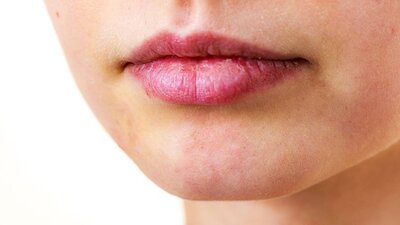 Dudak kanseri nedir?