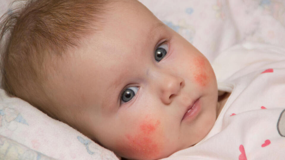 Bebeklerde alerji nedir?