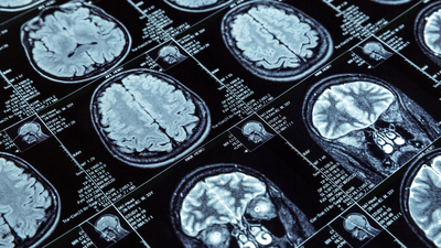 Türkiye bıçaksız beyin ameliyatlarında dünya lideri