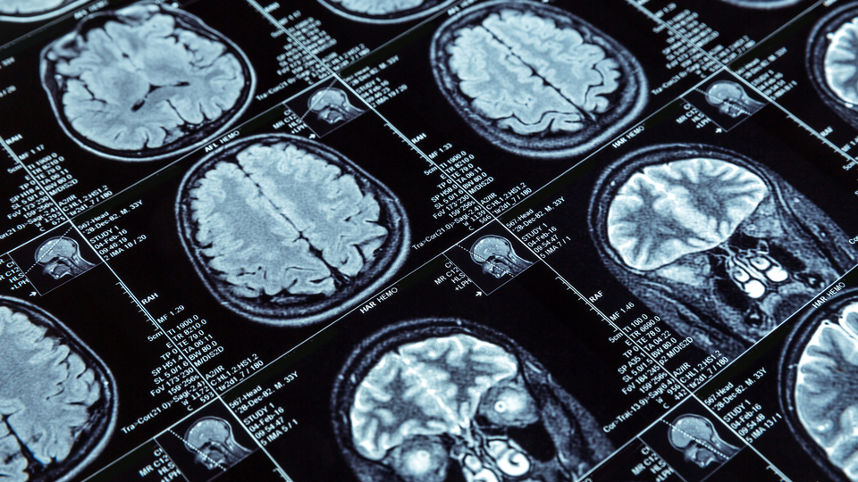 Türkiye bıçaksız beyin ameliyatlarında dünya lideri