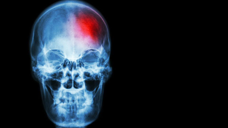 Her 40 saniyede bir kişi inme geçiriyor