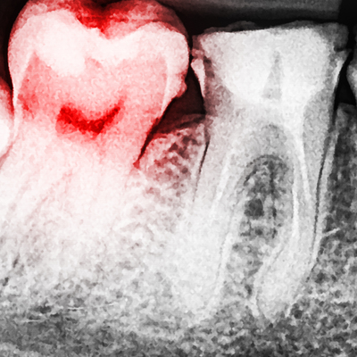 Dikkat! Zatürre riskini artırıyor