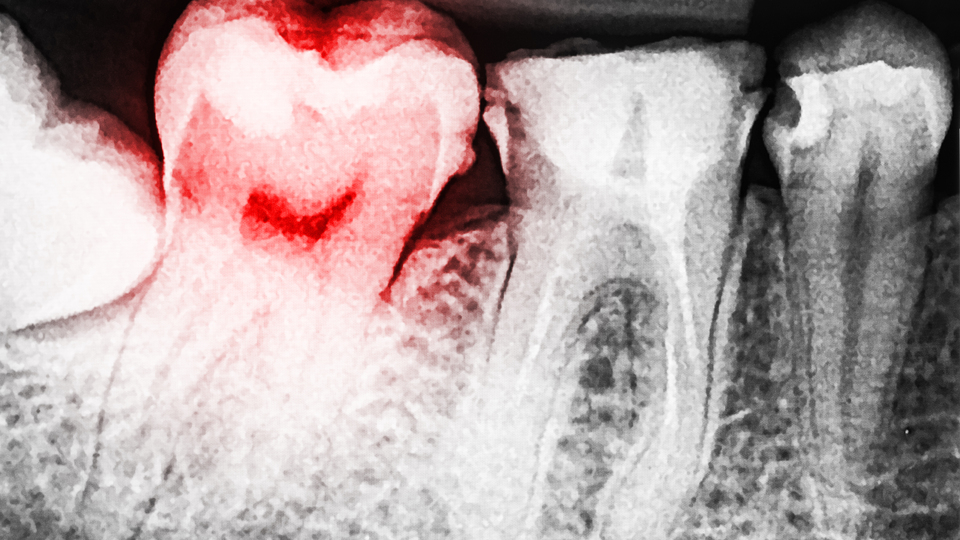 Dikkat! Zatürre riskini artırıyor