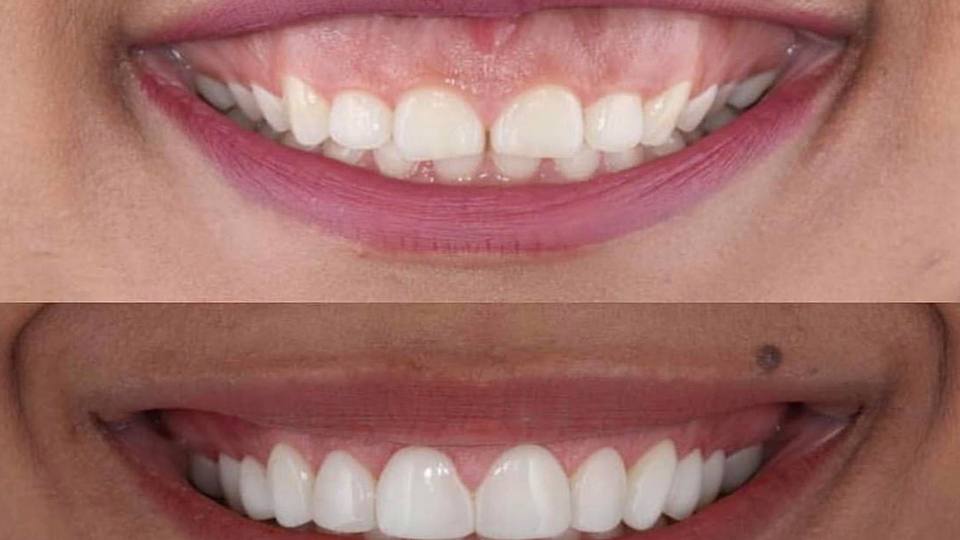 Diş eti hastalığı nasıl geçer?