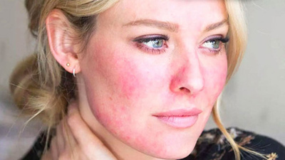 Yüzde kızarıklığa yol açan etkenler