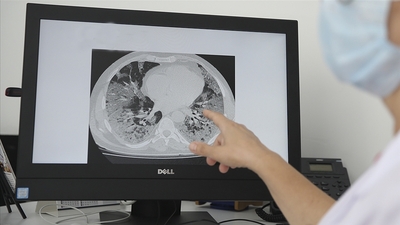 Covid-19 o hastalıktan ölümleri artırdı