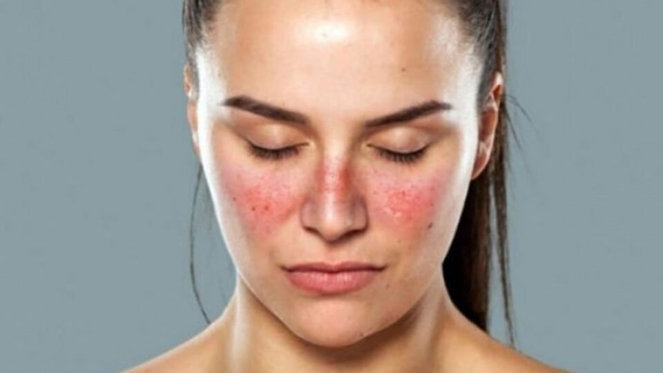 Kelebek Hastalığı nedir, belirtileri nelerdir?