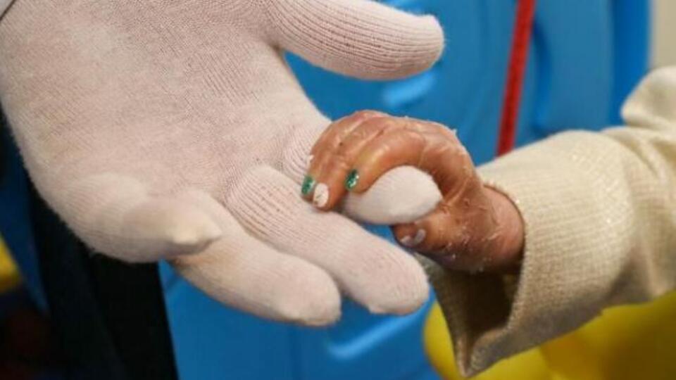 Kelebek Hastalığı nedir?