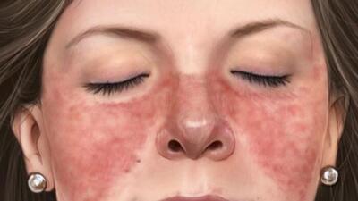 Kelebek hastalığı nedir?