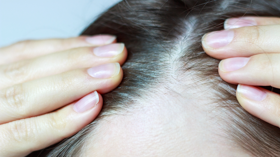 Koronavirüs saçları döküyor mu?