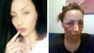 "Örümcek ağı" estetiğinde dehşeti yaşadı!