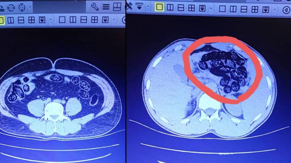 Midelerinden 103 kapsül çıktı
