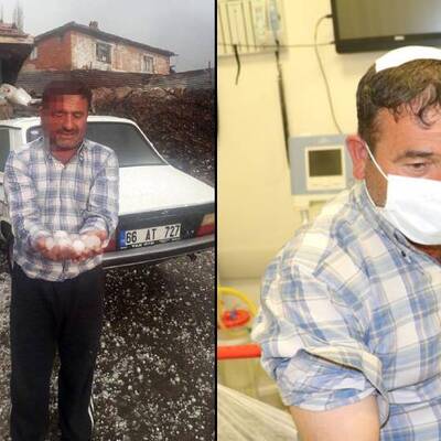 Yumurta büyüklüğündeki dolu hastanelik etti