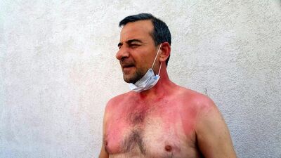 Sigara dumanı kavgası! Kaynar suyla yaktı