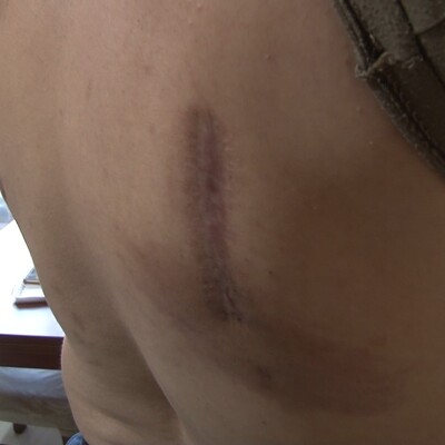 Şiddetli öksürük yüzünden kaburgaları kırıldı