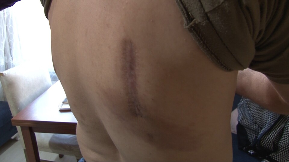 Şiddetli öksürük yüzünden kaburgaları kırıldı