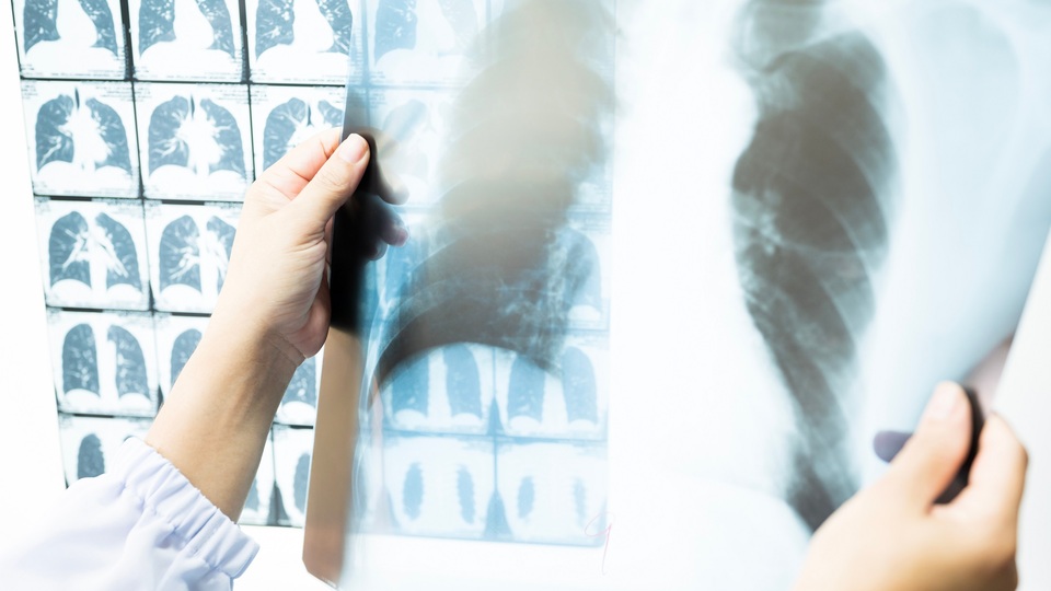 Amerikan Kanseri Derneği açıkladı! Akciğer kanserinde tarama yaşı düştü