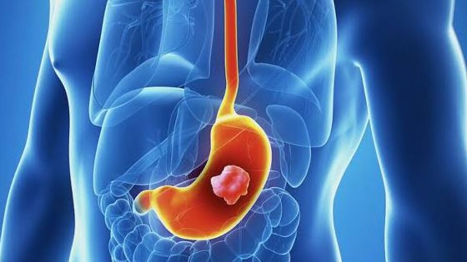 Dumping sendromu nedir?