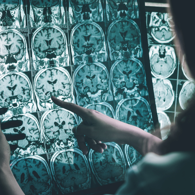 Alzheimer'dan korunmak için bıkıp usanmadan tekrar et