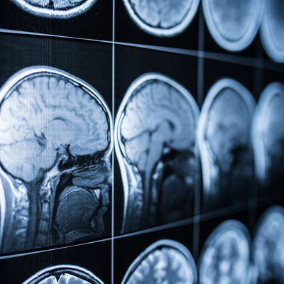 Uzak durun! Bu nedenler beyni erken yaşlandırıyor!