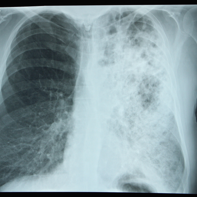 Bu belirtilere dikkat! Koronayla birleştiğinde...