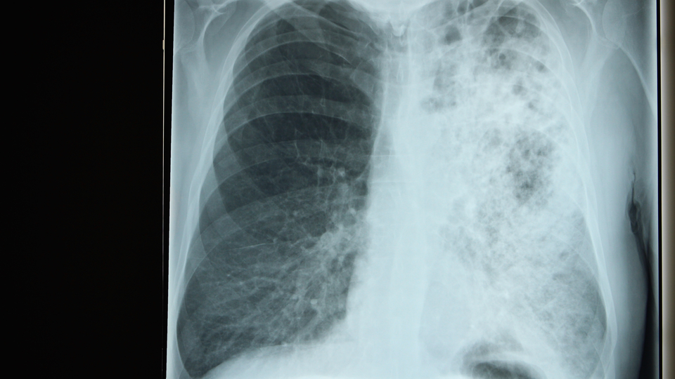 Bu belirtilere dikkat! Koronayla birleştiğinde...