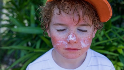 Güneş yanıklarına yoğurt sürüyorsanız dikkat!