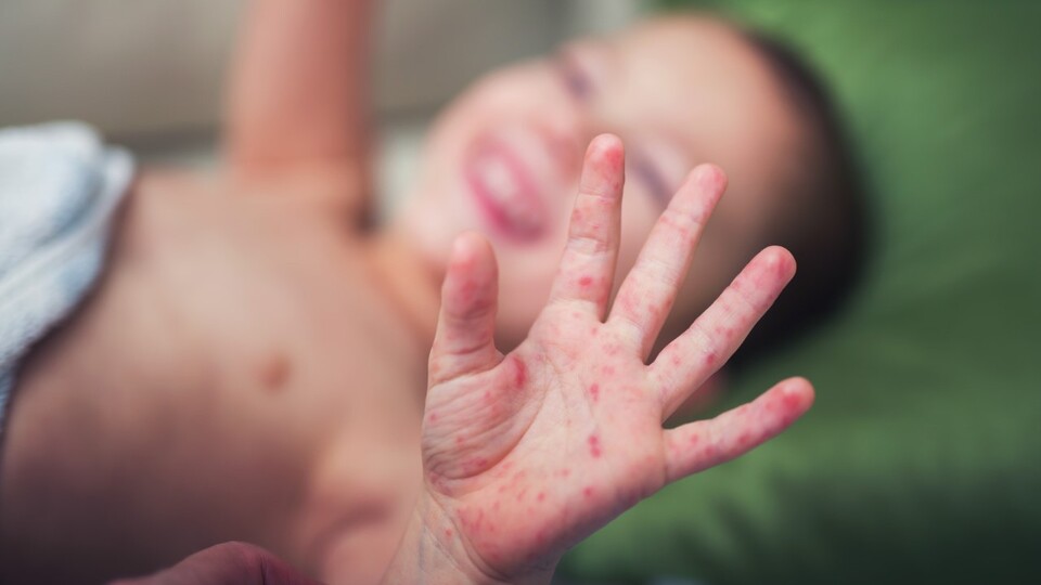 Uzmanından 'el, ayak, ağız hastalığı' uyarısı!