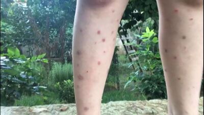 Dikkat çeken sivrisinek haritası