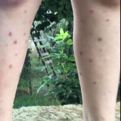 Dikkat çeken sivrisinek haritası