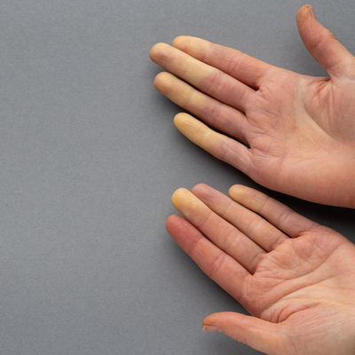 Bu belirtiyle ortaya çıkıyor! Tedavi edilmezse...