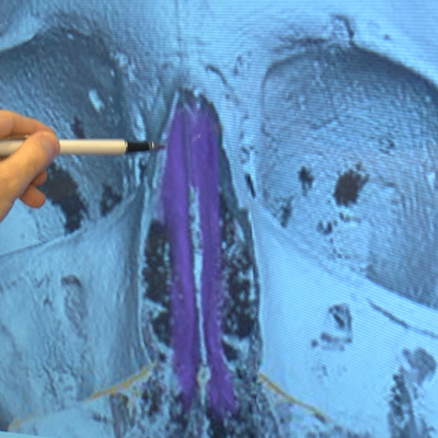 Türk doktorlar araştırdı! 'Tazı burun' olarak nitelenen kişilerde...