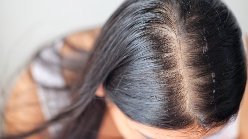 Pandemide 'saç dökülmesi' şikayeti arttı!