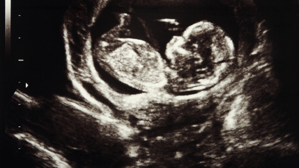 Korkunç etki! Gebelikte içilen sigara çocukta tümör sebebi