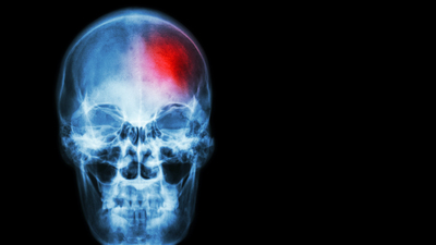 Uzmanı açıkladı! İnme ve Covid-19 aşılarının bağlantısı yok