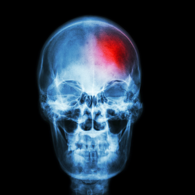 Uzmanı açıkladı! İnme ve Covid-19 aşılarının bağlantısı yok