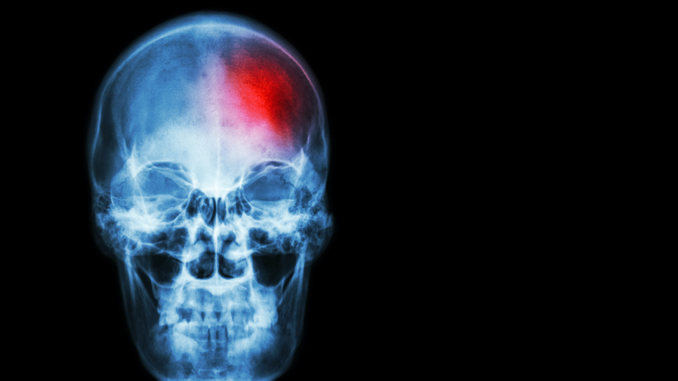 Uzmanı açıkladı! İnme ve Covid-19 aşılarının bağlantısı yok