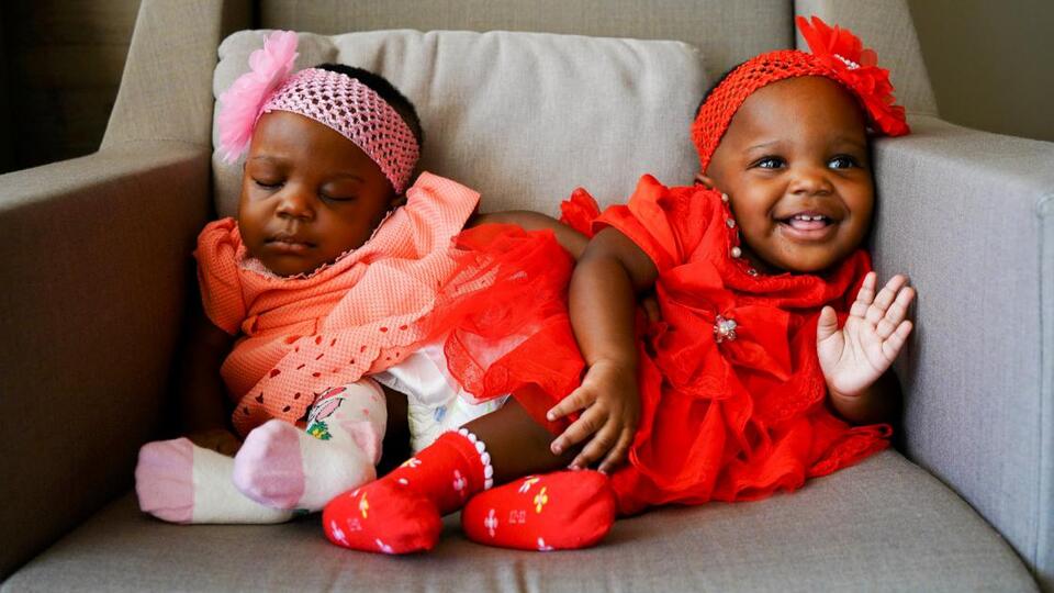 Yapışık siyam ikizleri, Türkiye'de şifa buldu